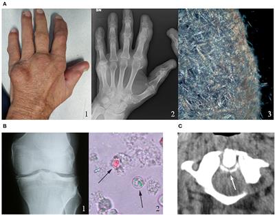 Autoinflammatory Mechanisms in Crystal-Induced Arthritis